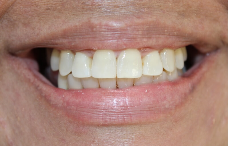 Clear Aligners 2 After