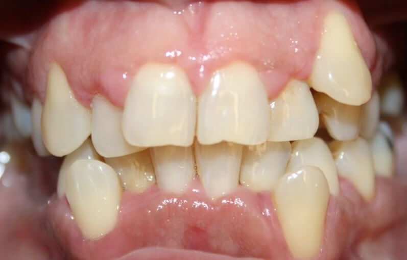 Clear Aligners 2 Before