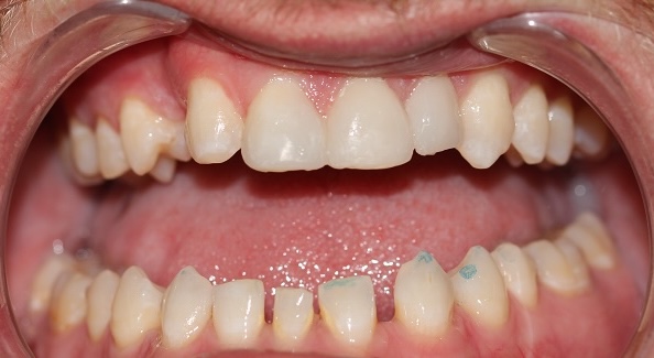 Dental Bonding 7 After