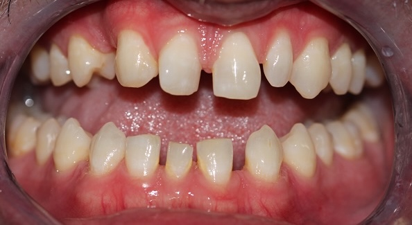 Dental Bonding 7 Before