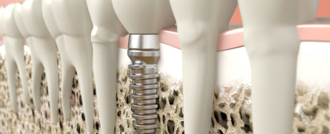 Rediscover the Joy of Eating with Dental Implants