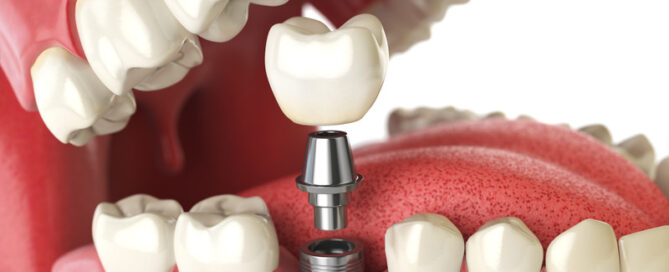 Navigating Dental Implants: Your Guide to a New Smile