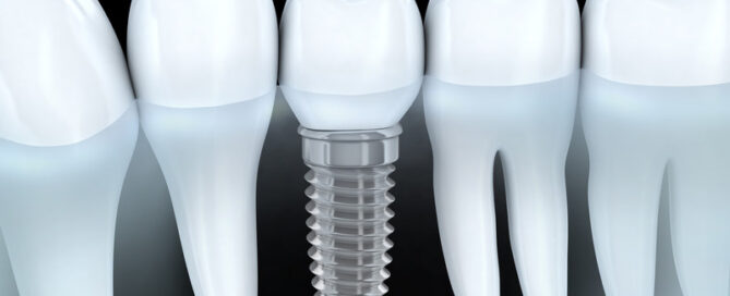 Dental Implants: Cavity-Free Smiles for a Lifetime