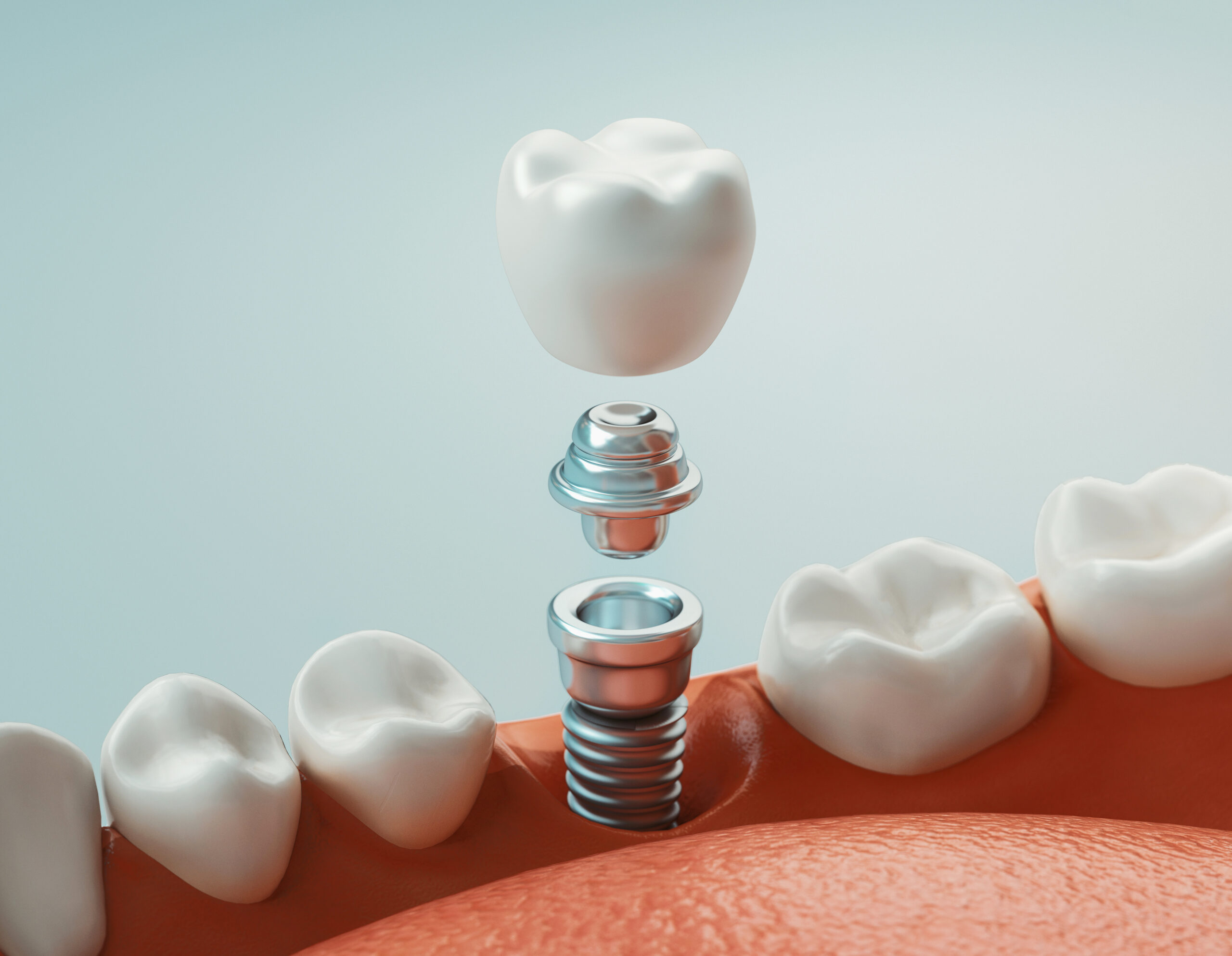 Dental care, dental implant, 3d rendering Close-up of a single tooth dental implant model, illustrating the titanium post and custom crown used at Dominion Smiles in San Antonio
