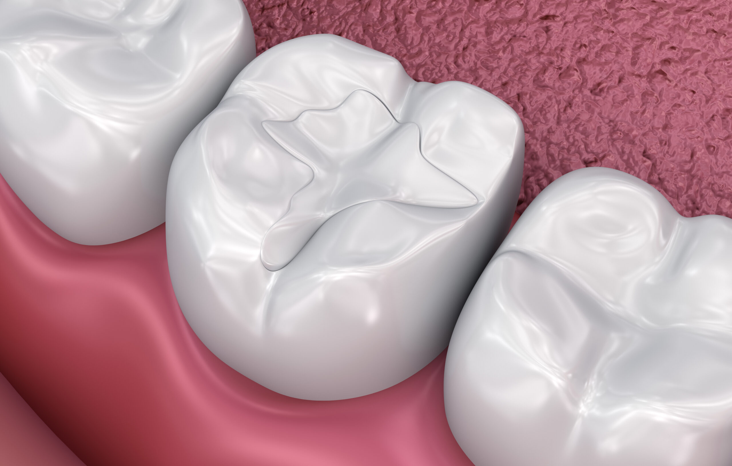 Dental model showing porcelain tooth fillings at Dominion Smiles in San Antonio, TX